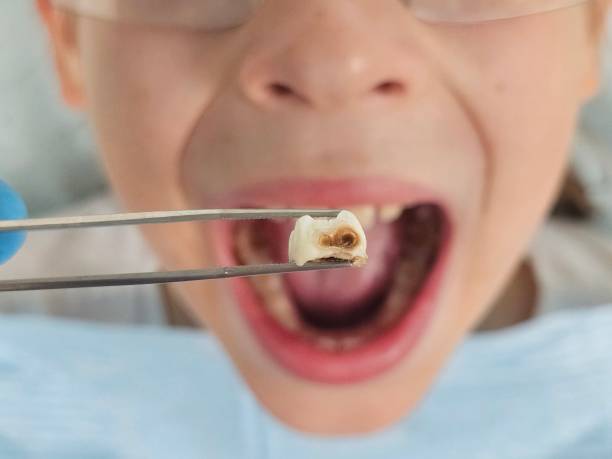 Best Emergency Treatment for Toothache in Wellford, SC